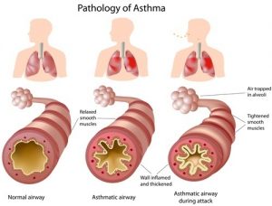Asthma is narrowing of bronchi