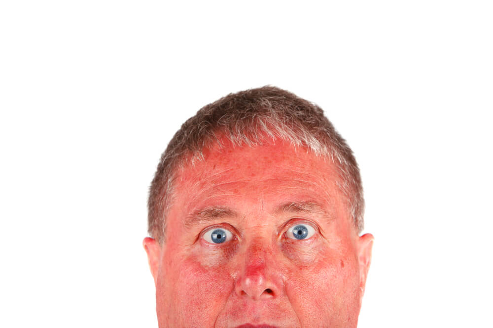 Sunburn: What Can Be Done?